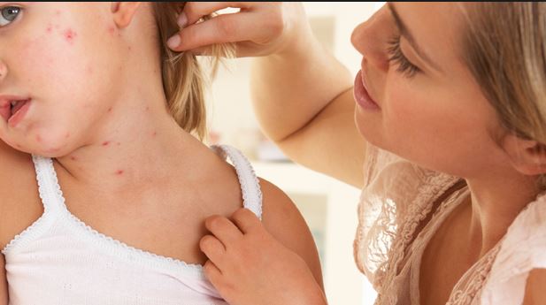 Tuhkarokkorokotteen saanut lapsi, jolla on terve iho